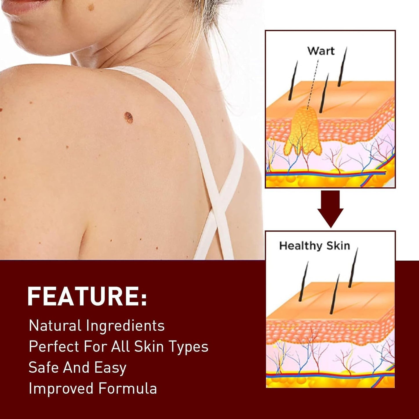 SkinClear™ – Painless Skin Tag & Mole Remover | Fast, Safe & Natural (Pack of 2)