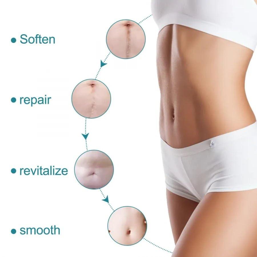 Silicone Gel Tape– Gentle Scar Reduction Therapy