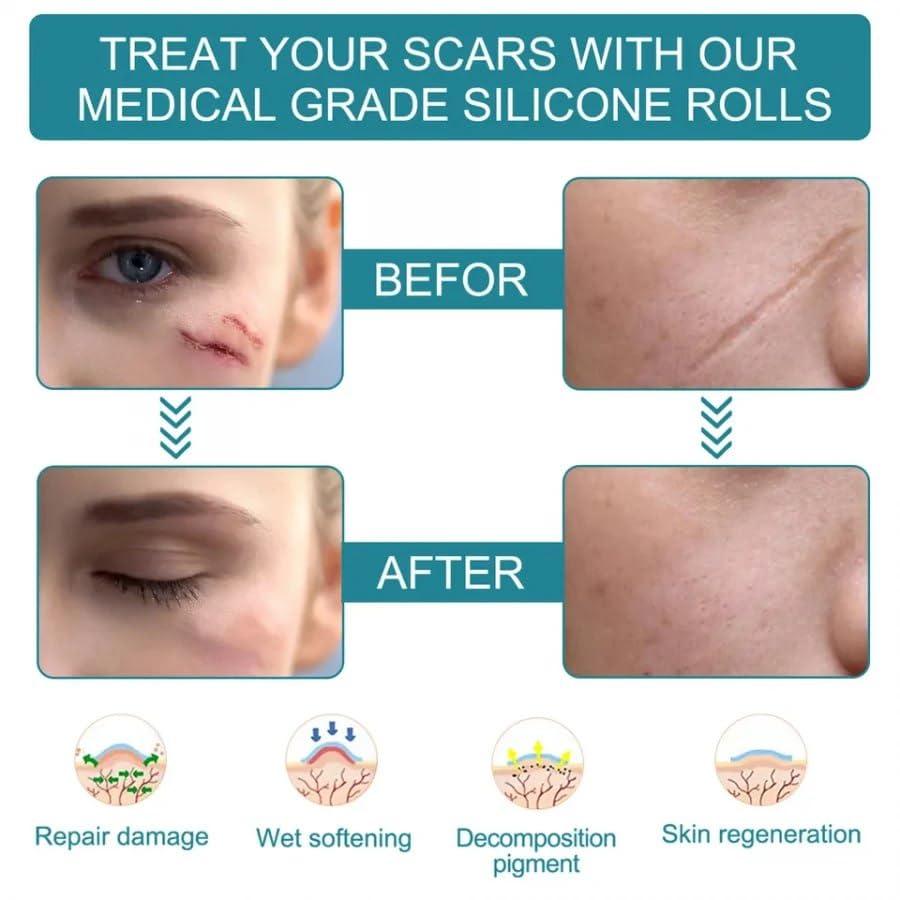 Silicone Gel Tape– Gentle Scar Reduction Therapy