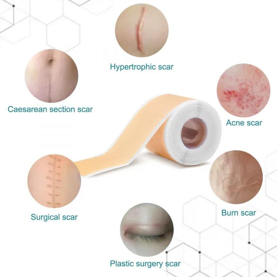 Silicone Gel Tape– Gentle Scar Reduction Therapy