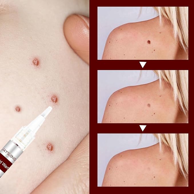 SkinClear™ – Painless Skin Tag & Mole Remover | Fast, Safe & Natural (Pack of 2)