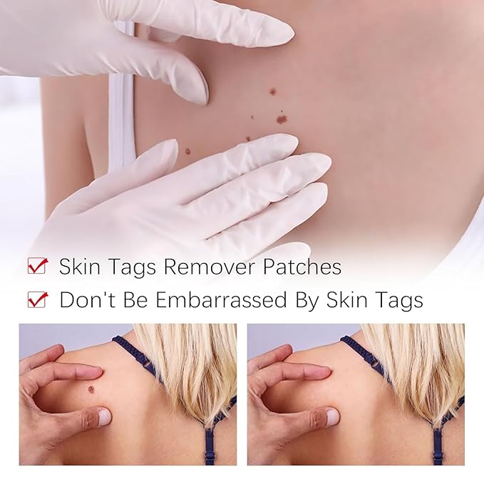 SkinClear™ – Painless Skin Tag & Mole Remover | Fast, Safe & Natural (Pack of 2)