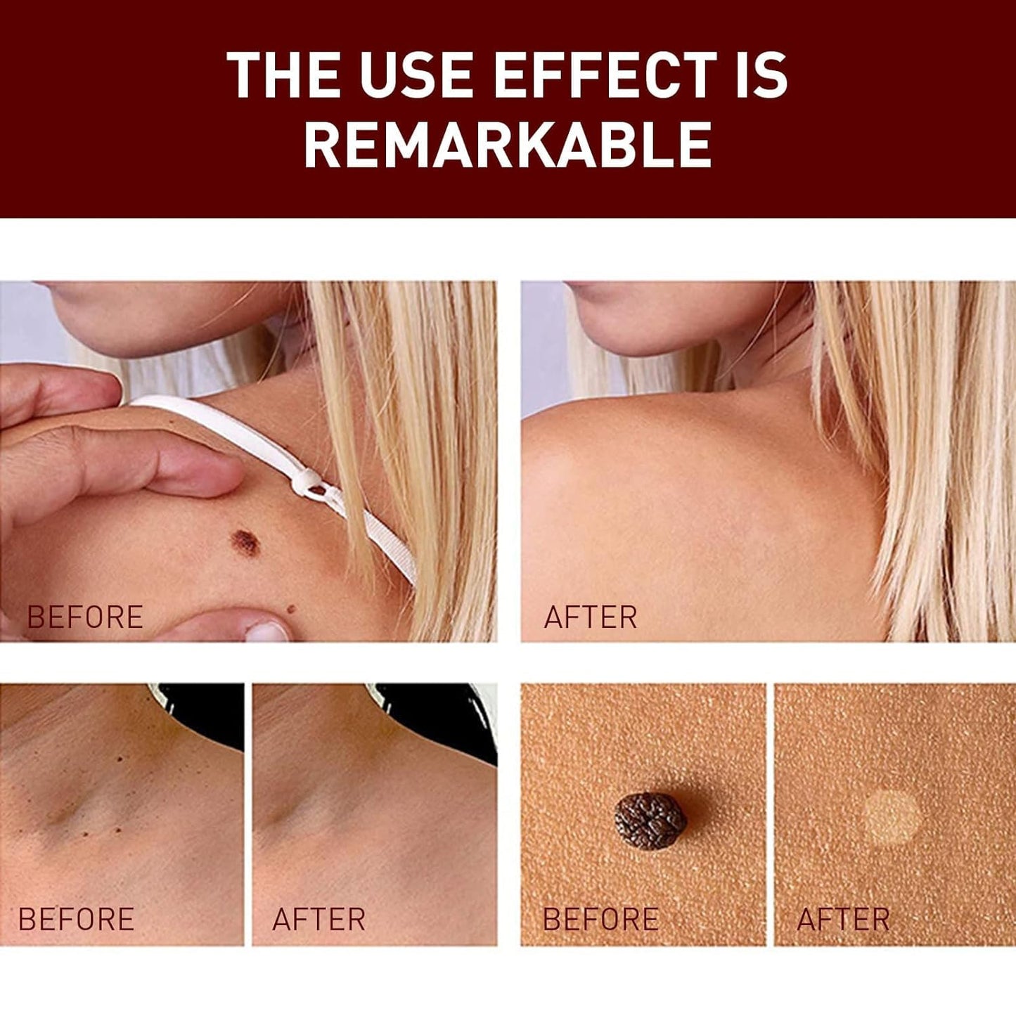 SkinClear™ – Painless Skin Tag & Mole Remover | Fast, Safe & Natural (Pack of 2)